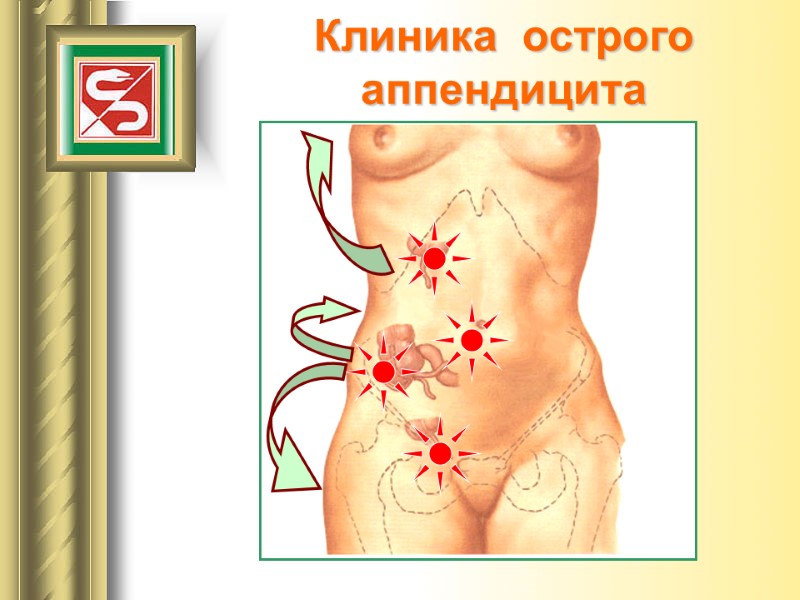 Клиника  острого  аппендицита